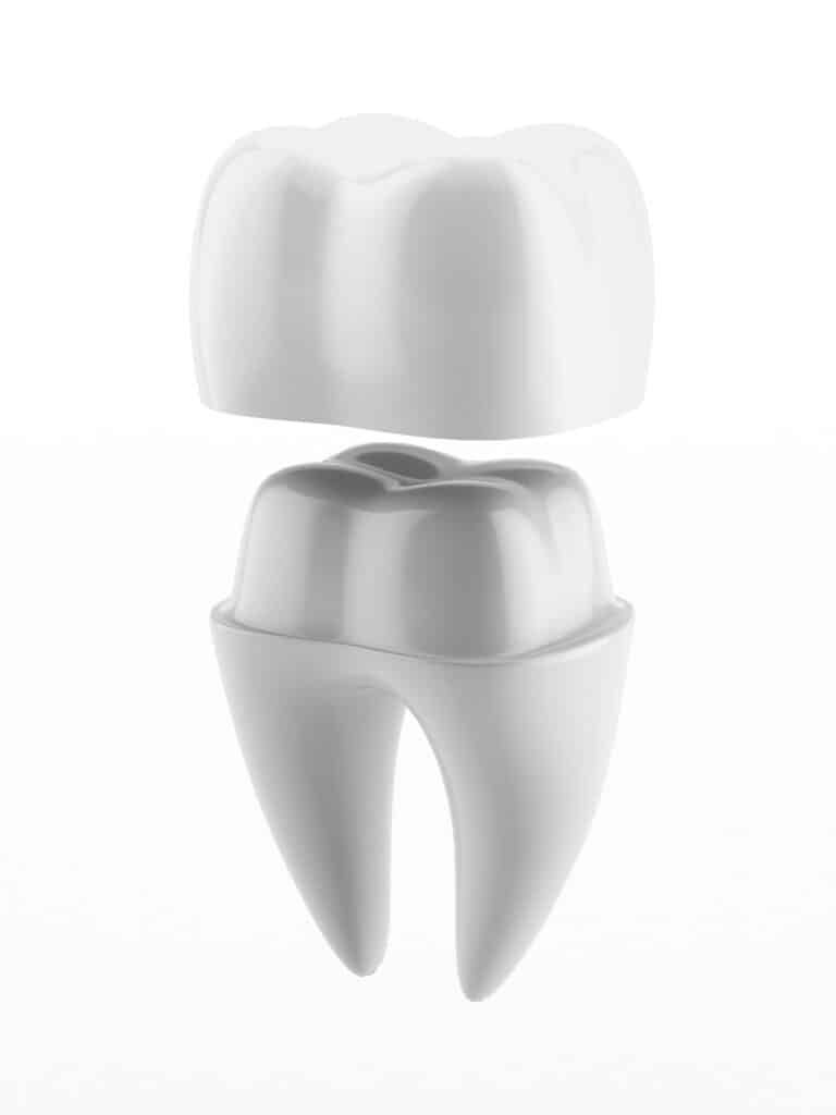 Eric Felt DDS Cottonwood Heights Utah dental crowns and tooth