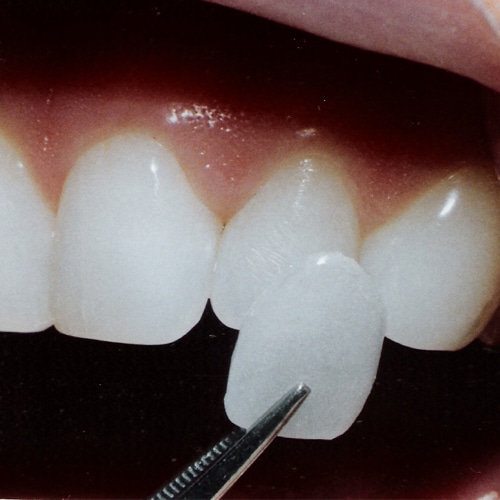 Why You Should Avoid Veneer Technicians veneer technician