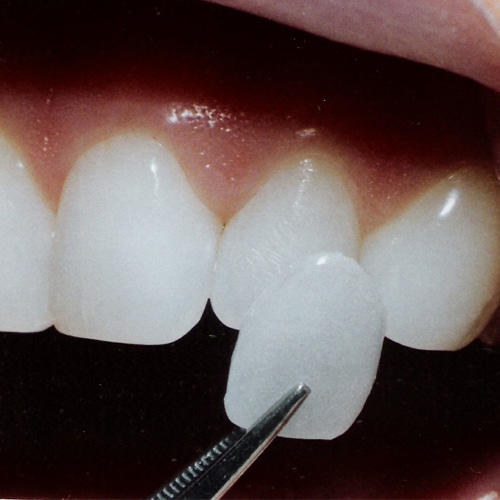 Cottonwood Heights Dental Veneers 