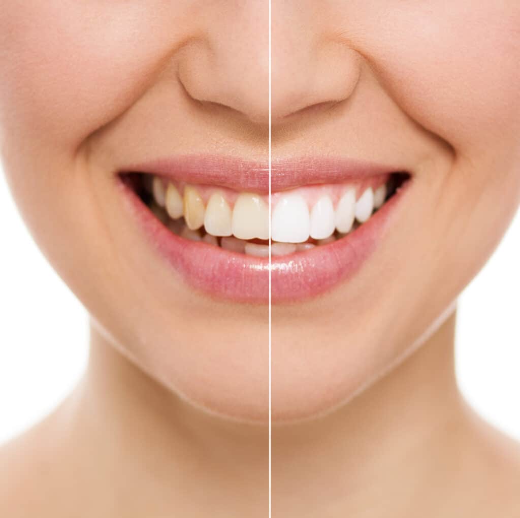Cottonwood Heights Teeth Whitening