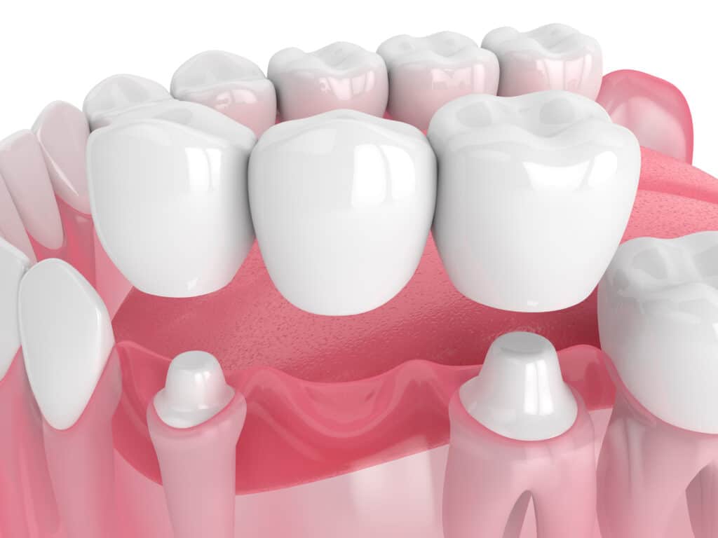 Dental Bridges dental bridge cottonwood heights utah