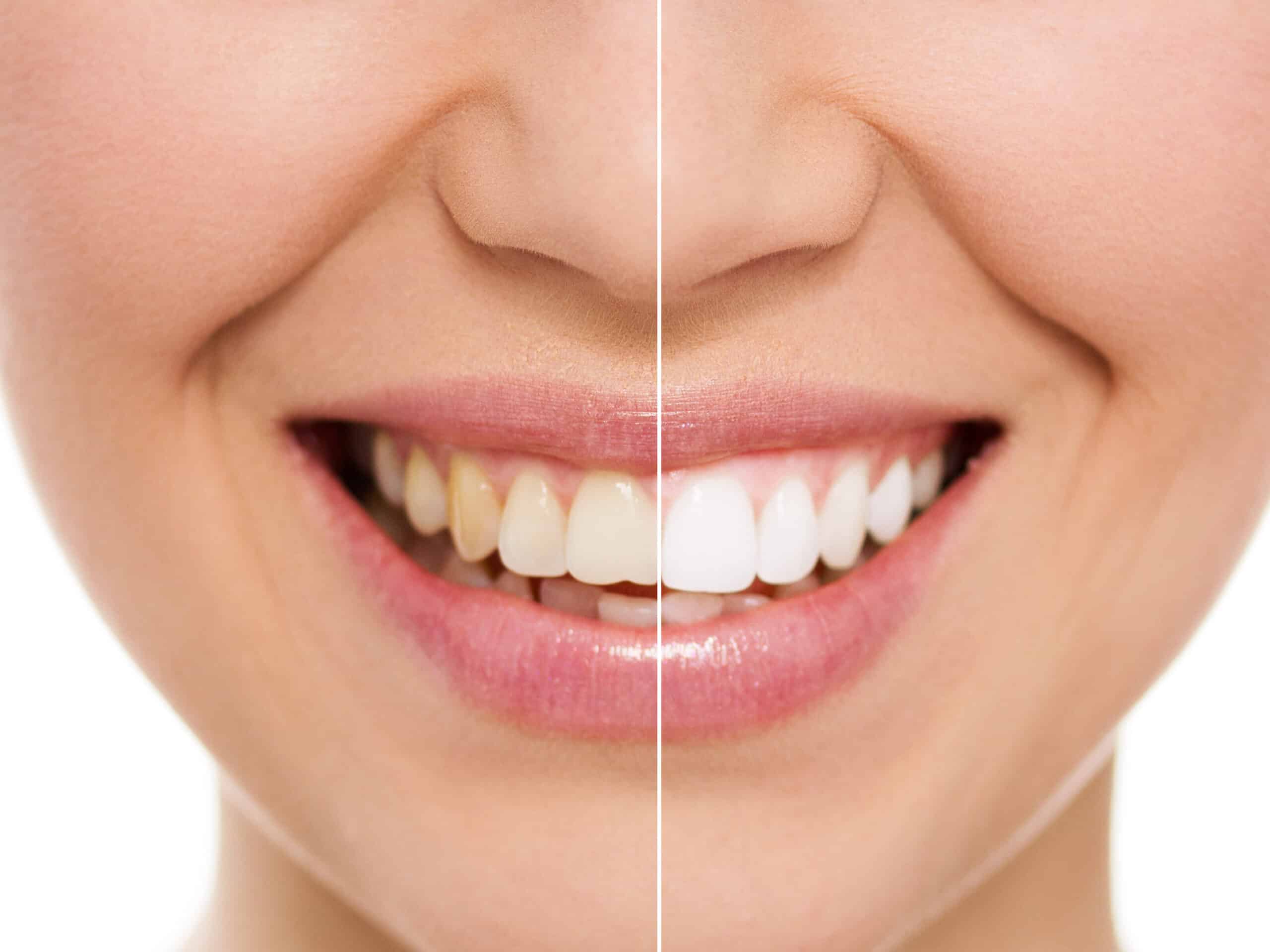 Tooth Discoloration: Causes, Treatment, and Prevention