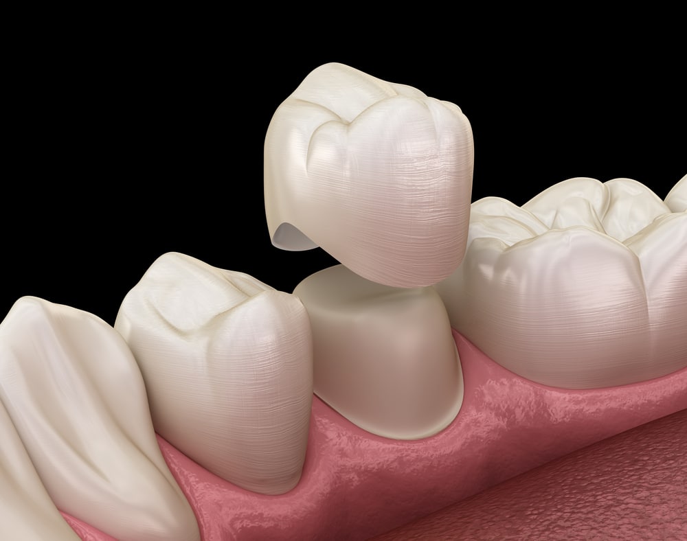 Pediatric Dental Crowns: 6 Things You Should Know