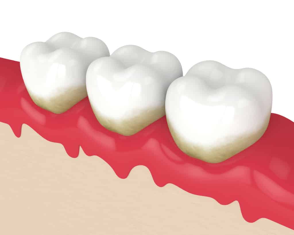 Answers to 5 Important Questions About Gum Health