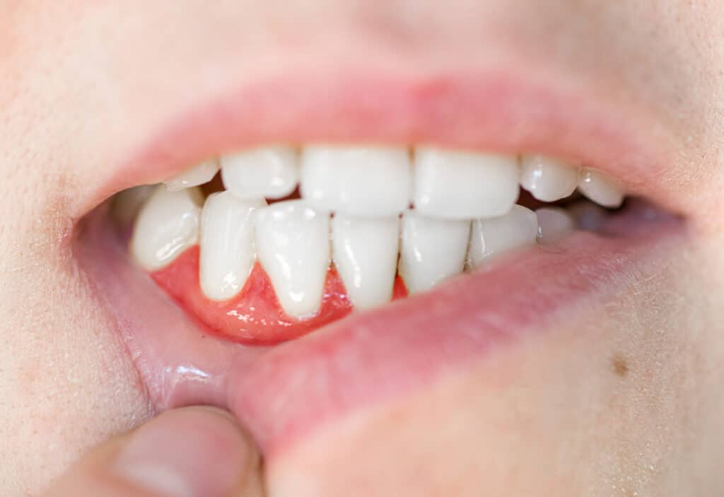 Answers to 5 Questions About Gum Health / effects of tobacco on oral health Cottonwood Heights UT