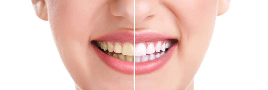 magic eraser teeth whitening Cottonwood Heights UT