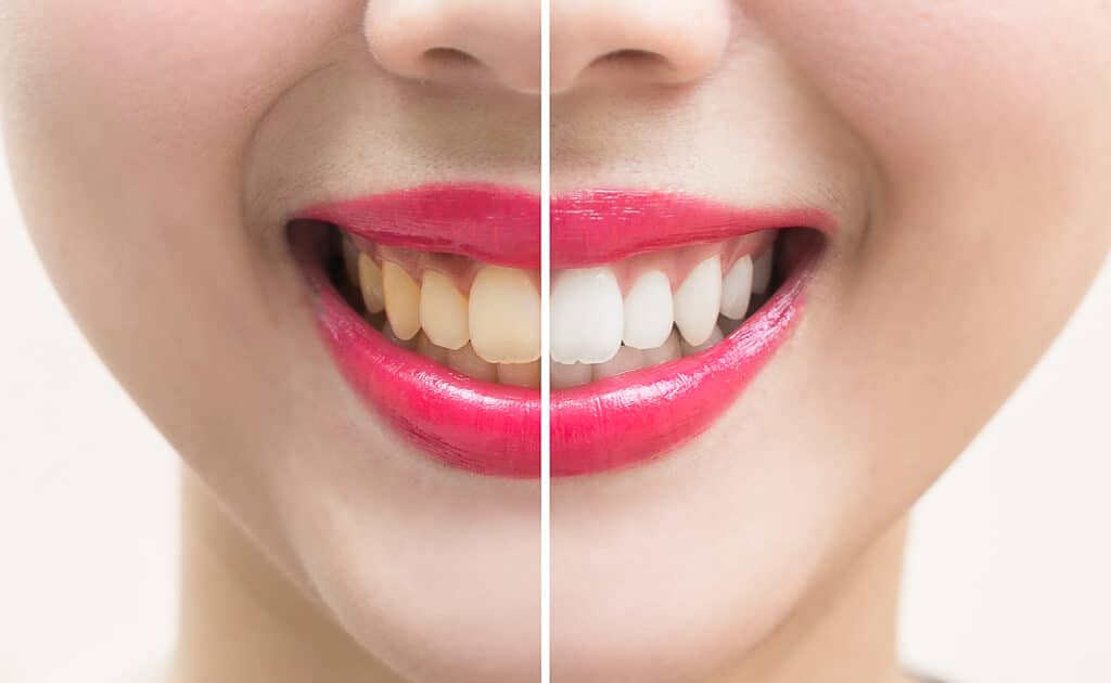 Is DIY Teeth Whitening Effective?