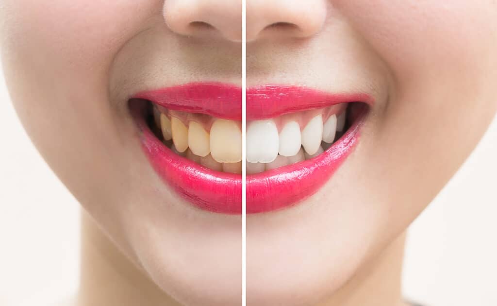 diy teeth whitening Cottonwood Heights UT