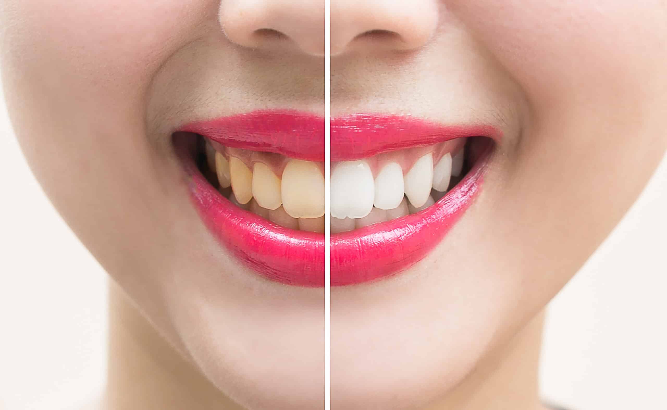 diy teeth whitening Cottonwood Heights