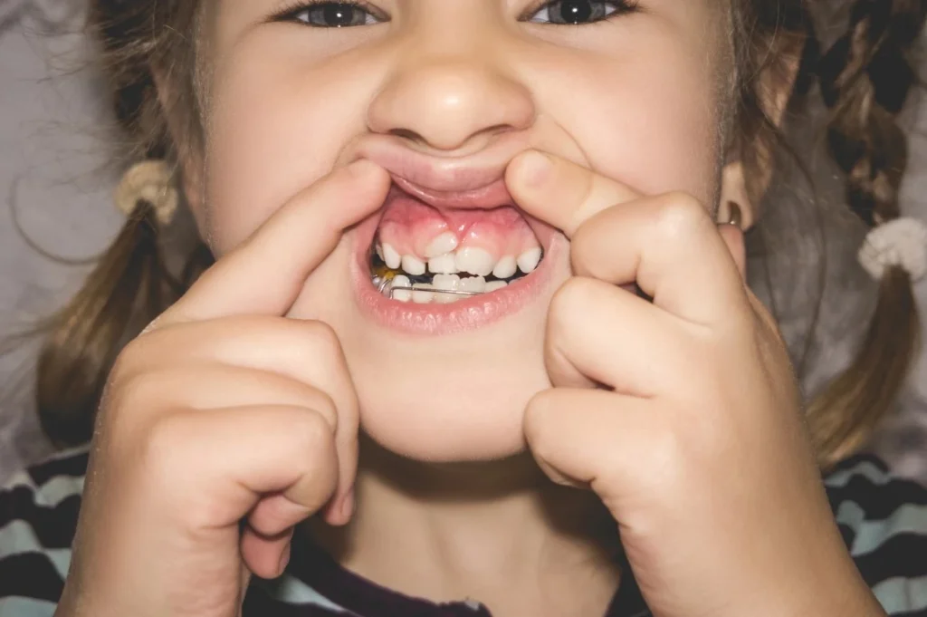 Why Does My Child Have A Double Row Of Teeth? double row of teeth Cottonwood Heights UT