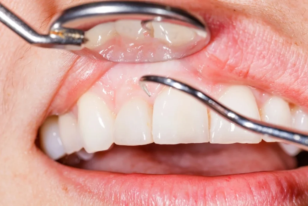 13 Frequently Asked Questions About Periodontal Disease Periodontal Disease, Cottonwood Heights, Utah