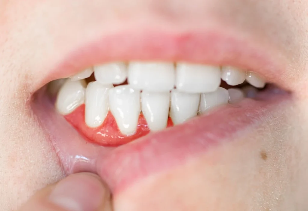 13 Frequently Asked Questions About Periodontal Disease Periodontal Disease, Cottonwood Heights, Utah